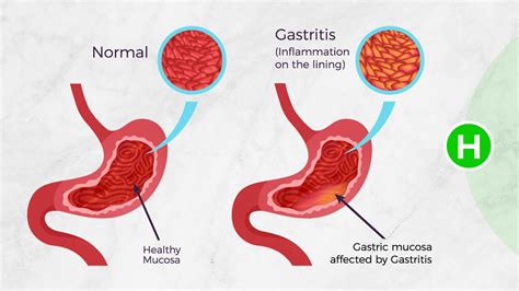 In addition, they can help with depression and insomnia, which . . Can niacin cause gastritis